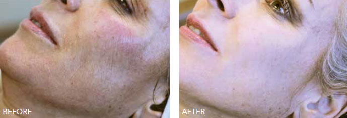 Skin Booster treatments